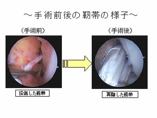 靭帯 前 術 十字 再建