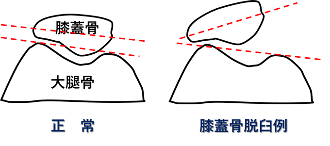 反復性膝蓋骨脱臼と内側膝蓋大腿靭帯（MPFL）再建術