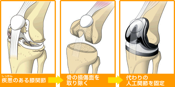 コンディション詳細TKA・UKA 人工膝関節置換術パーフェクト?人工膝関節 